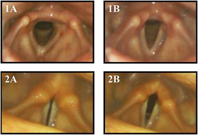 The Shaking Palsy of the Larynx—Potential Biomarker for Multiple System Atrophy: A Pilot Study and Literature Review